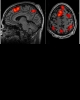 FMRI scans uncover “hot spots” of tellurian mind activity as subjects perform memory tasks.