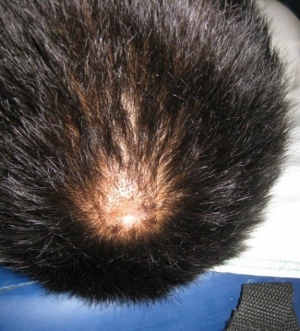 Photo 7 scalp abscess