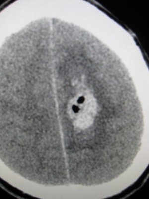 Photo 9 Brain abscess in the brain CT