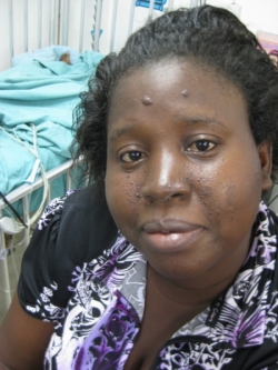 Child’s mother with scleroderma lesions