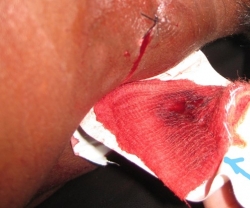 Stab wound to thigh and stingray stinger (arrow)