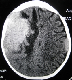 Neuroblastoma eroding skull